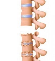 Stadiums of ramps of osteochondrosis of the neck