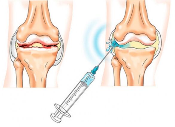 intra-articular injections for knee osteoarthritis