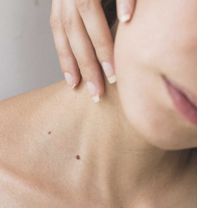 Stiffness in the neck is one of the symptoms in the initial stages of osteochondrosis of the cervical spine