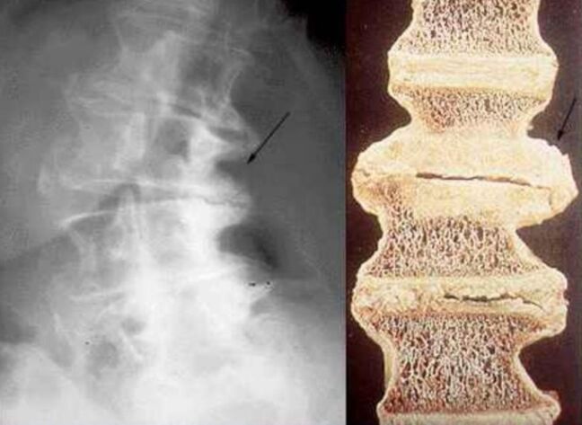 Damage to the vertebrae in thoracic osteochondrosis