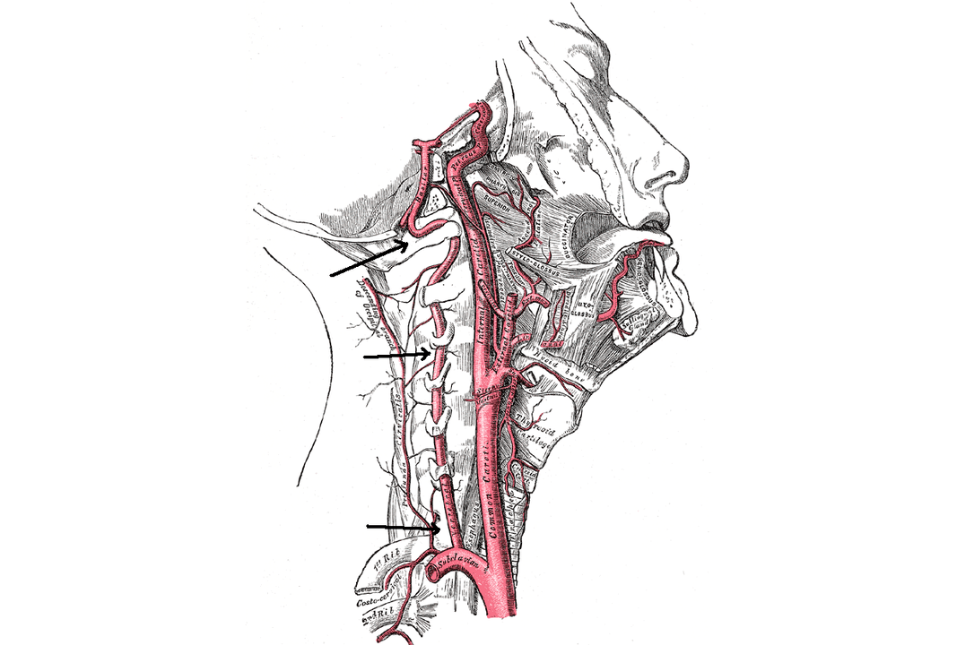 Compression of the vertebral artery with cervical osteochondrosis