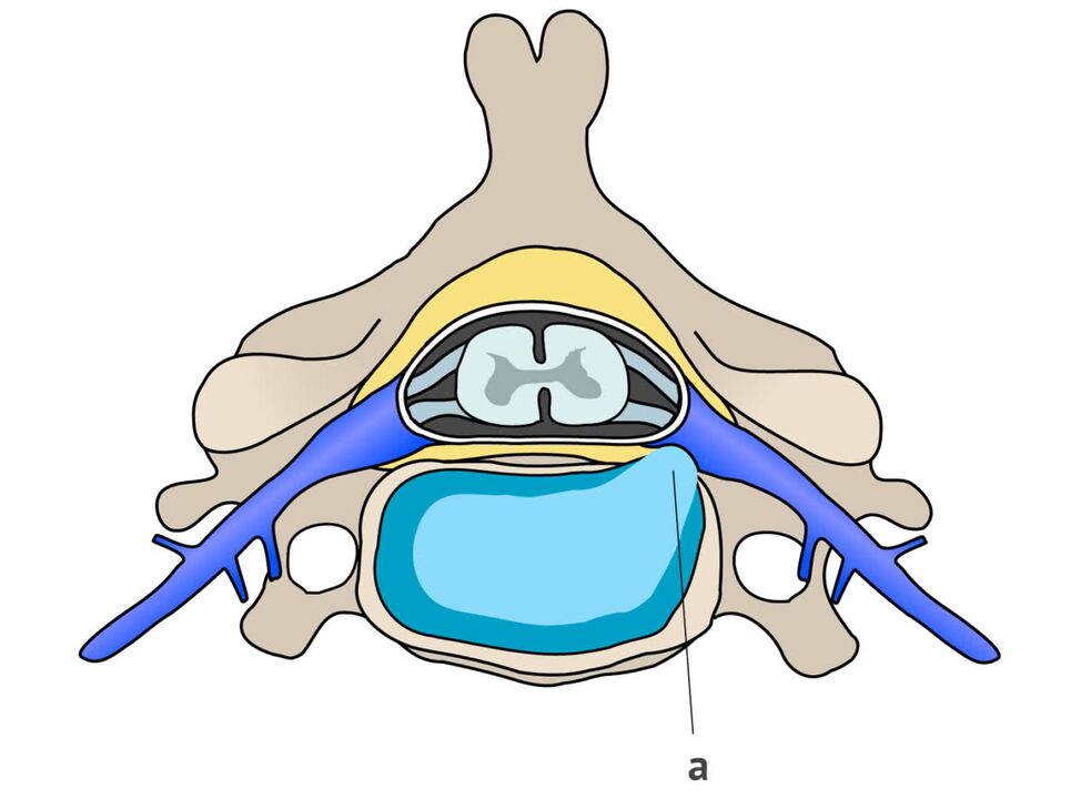 Intervertebral hernia with cervical osteochondrosis